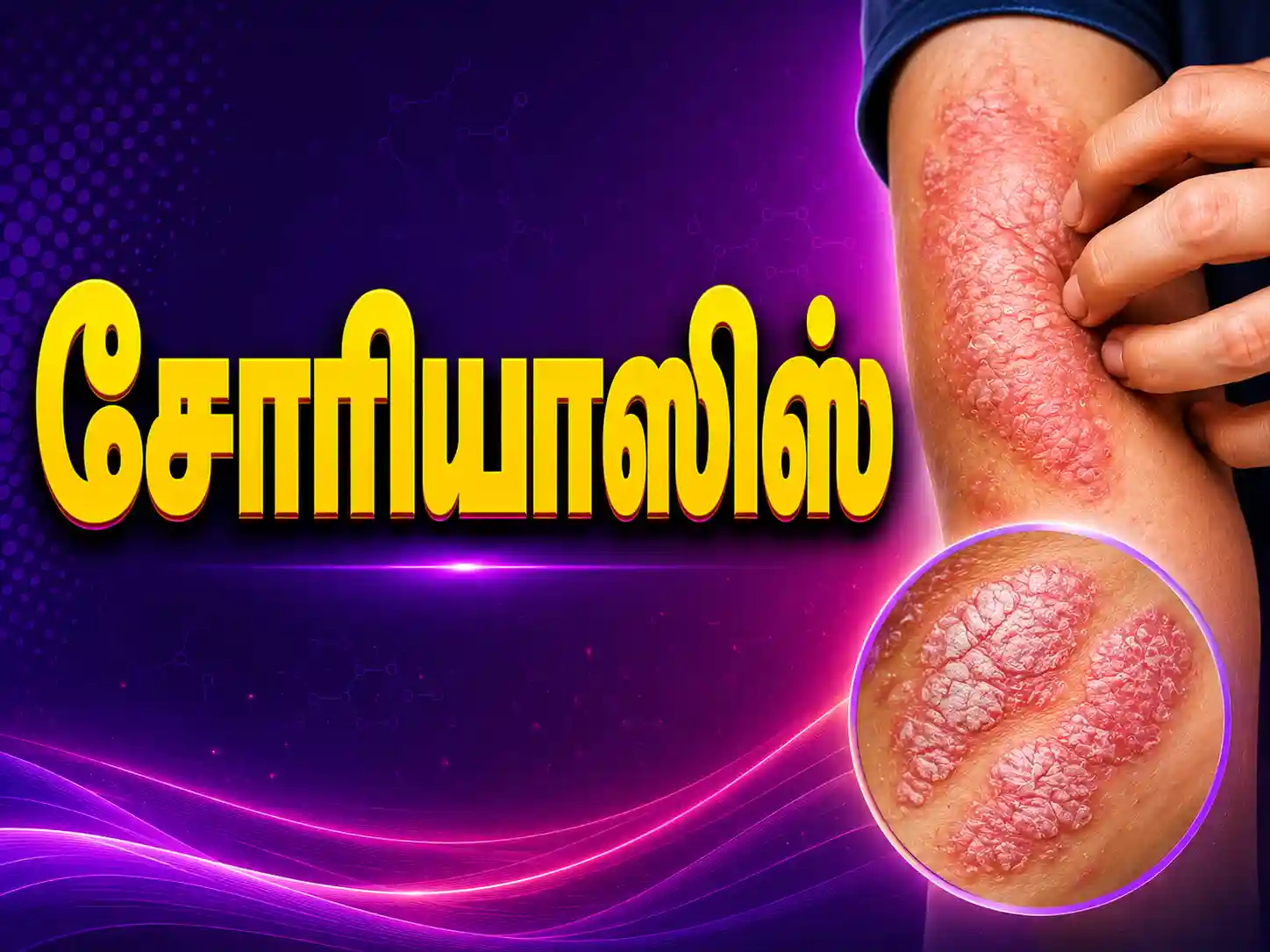 Psoriasis treatment in Karur