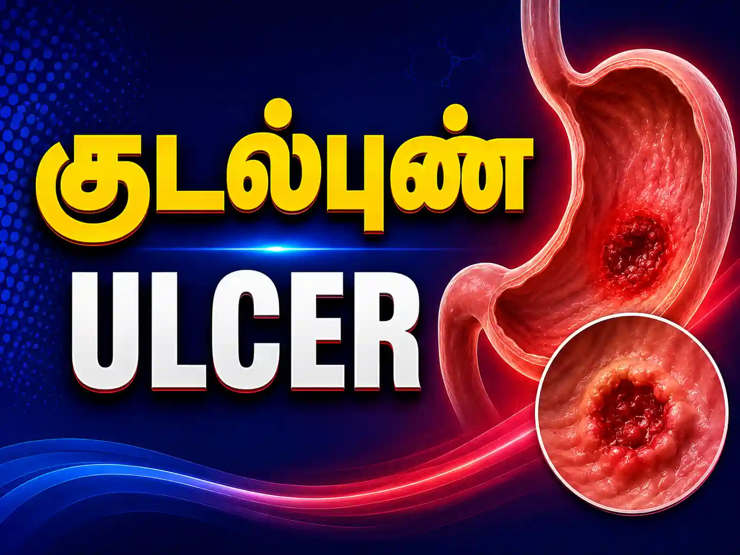 Ulcer treatment in Karur