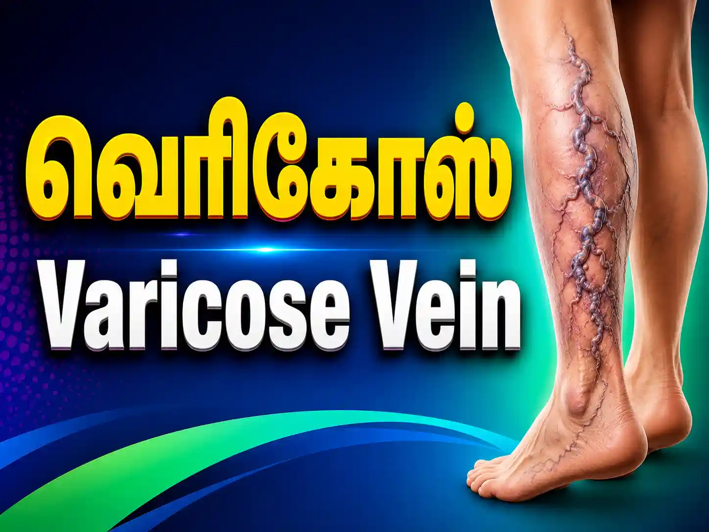 Varicose Veins treatment in Karur